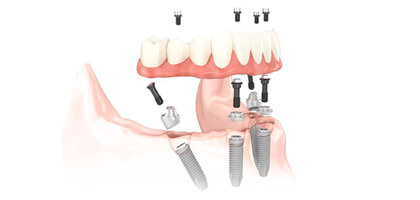 Implantes dentales precios ¿afecta éste a la calidad del implante?