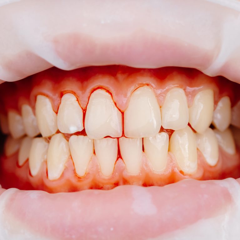 Close-up of patient teeth during dental examination showing cheek retractor and healthy gums