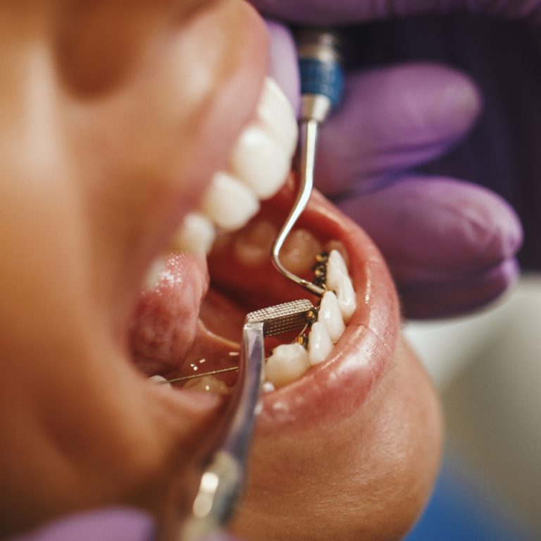 Cropped shot of a beautiful young woman is at the dentist. She sits in the dentist's chair and the dentist sets braces on her teeth putting aesthetic self-aligning lingual locks.